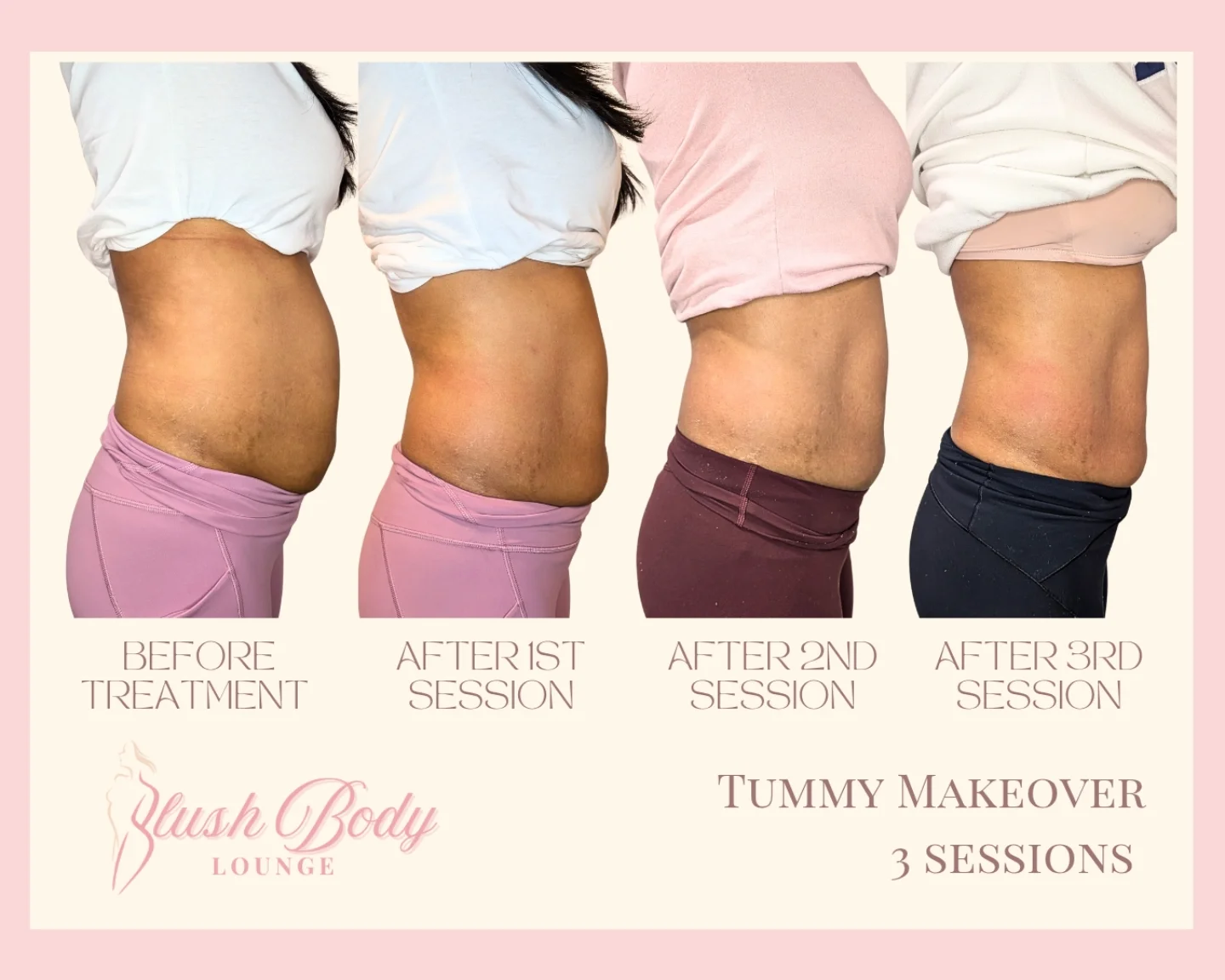Tummy Makeover — 3 Sessions client result