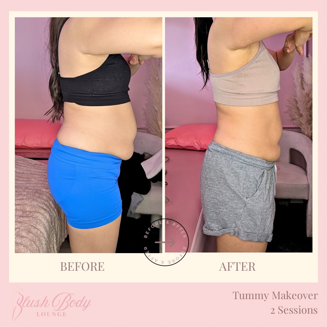 Tummy Makeover — 2 Sessions client result