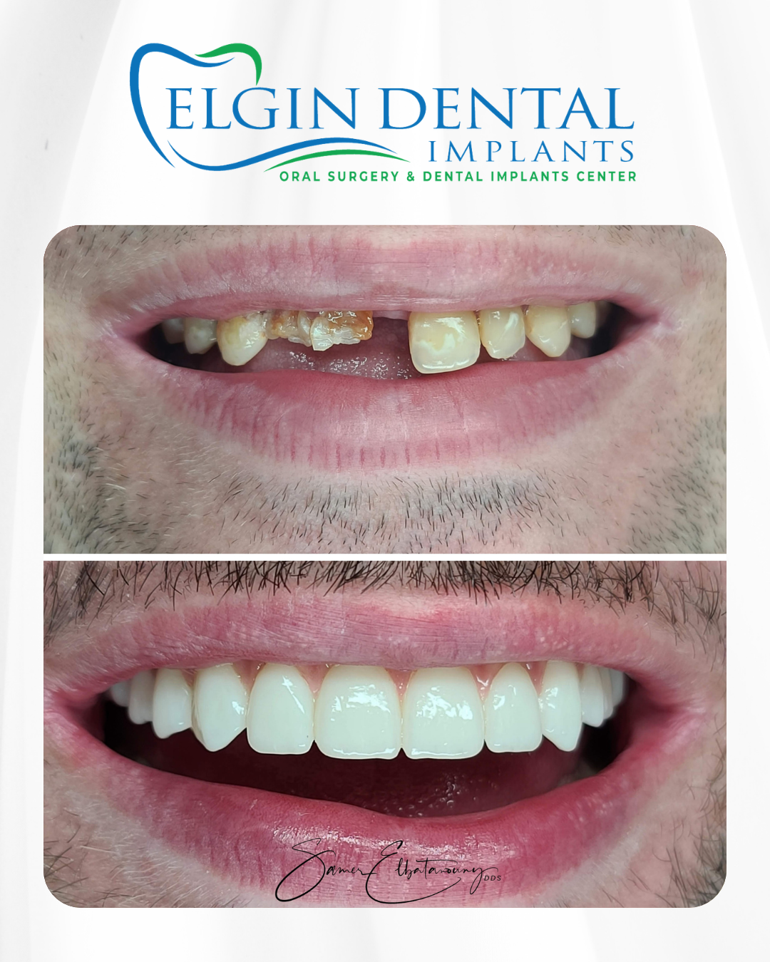 Elgin Dental Implants smile transformation 5, before and after