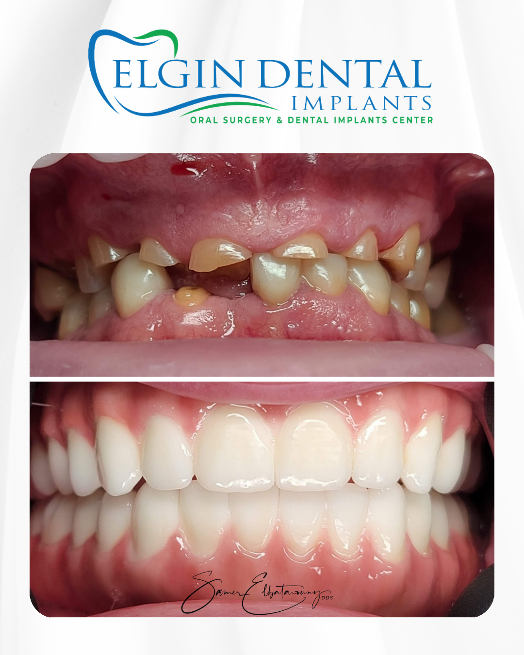 Elgin Dental Implants smile transformation 7, before and after