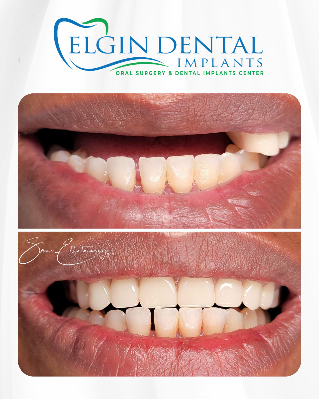 Elgin Dental Implants smile transformation 3, before and after