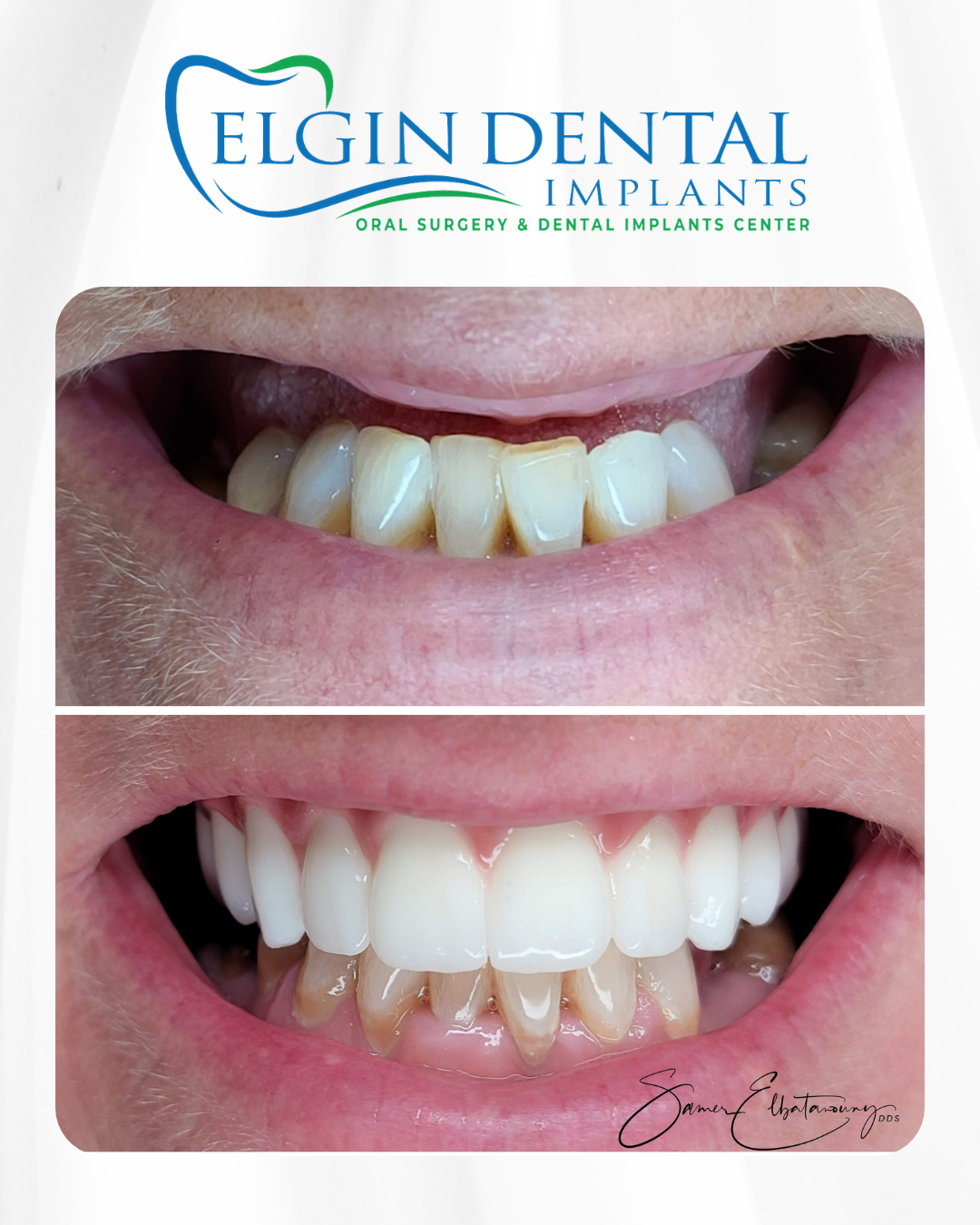 Elgin Dental Implants smile transformation 6, before and after