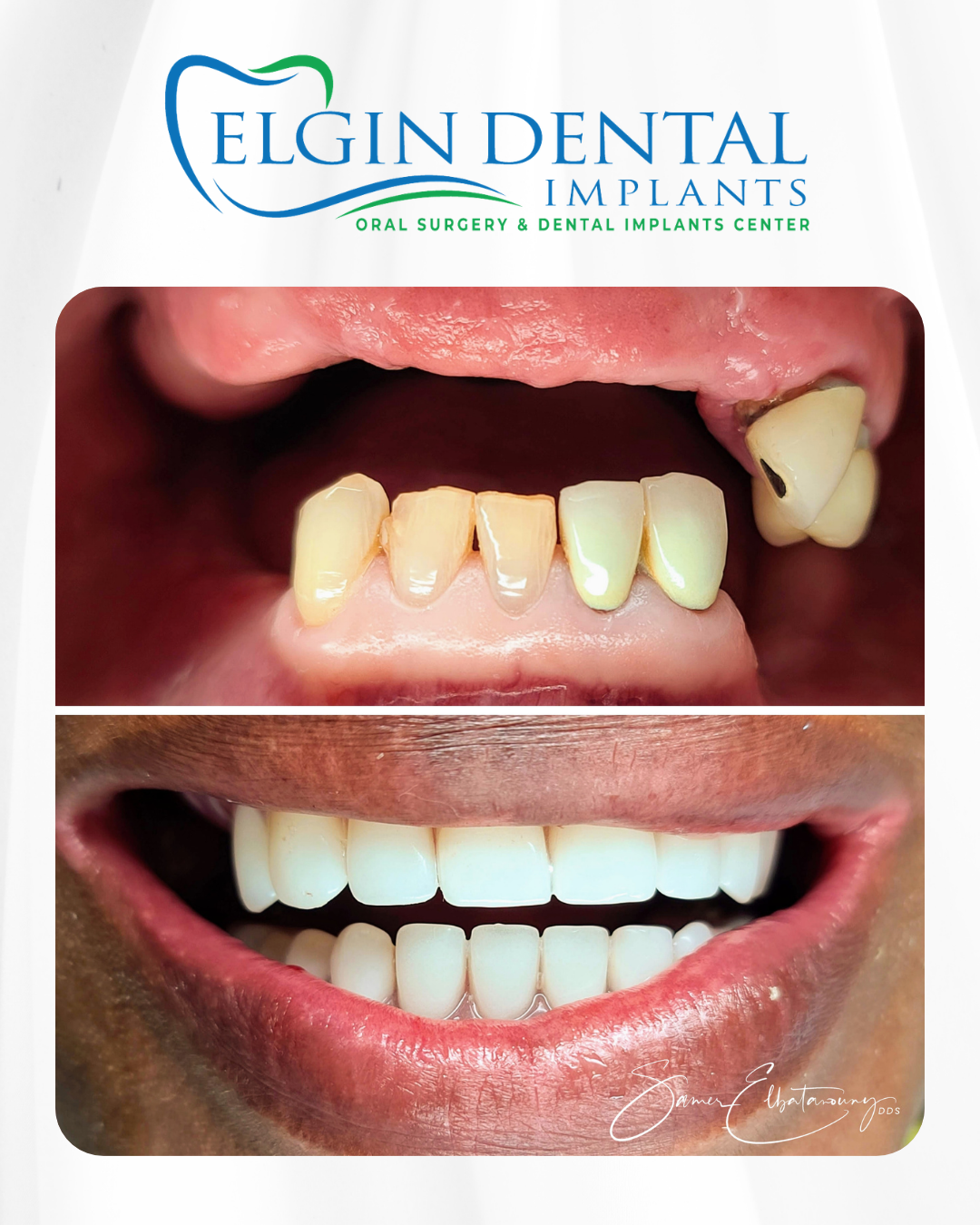 Elgin Dental Implants smile transformation 4, before and after
