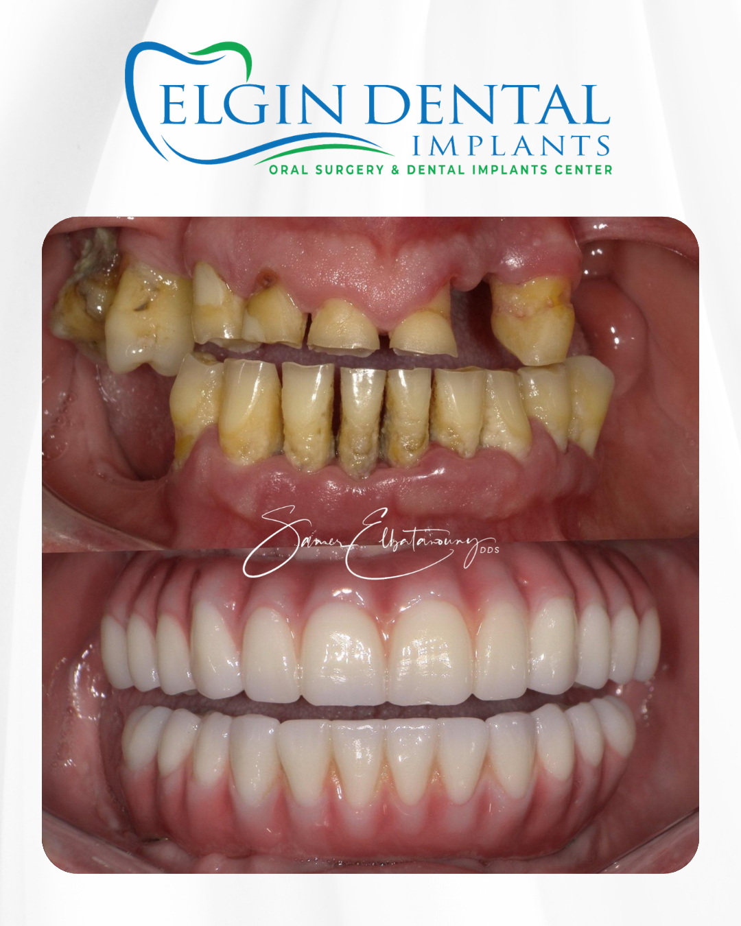 Elgin Dental Implants smile transformation 2, before and after