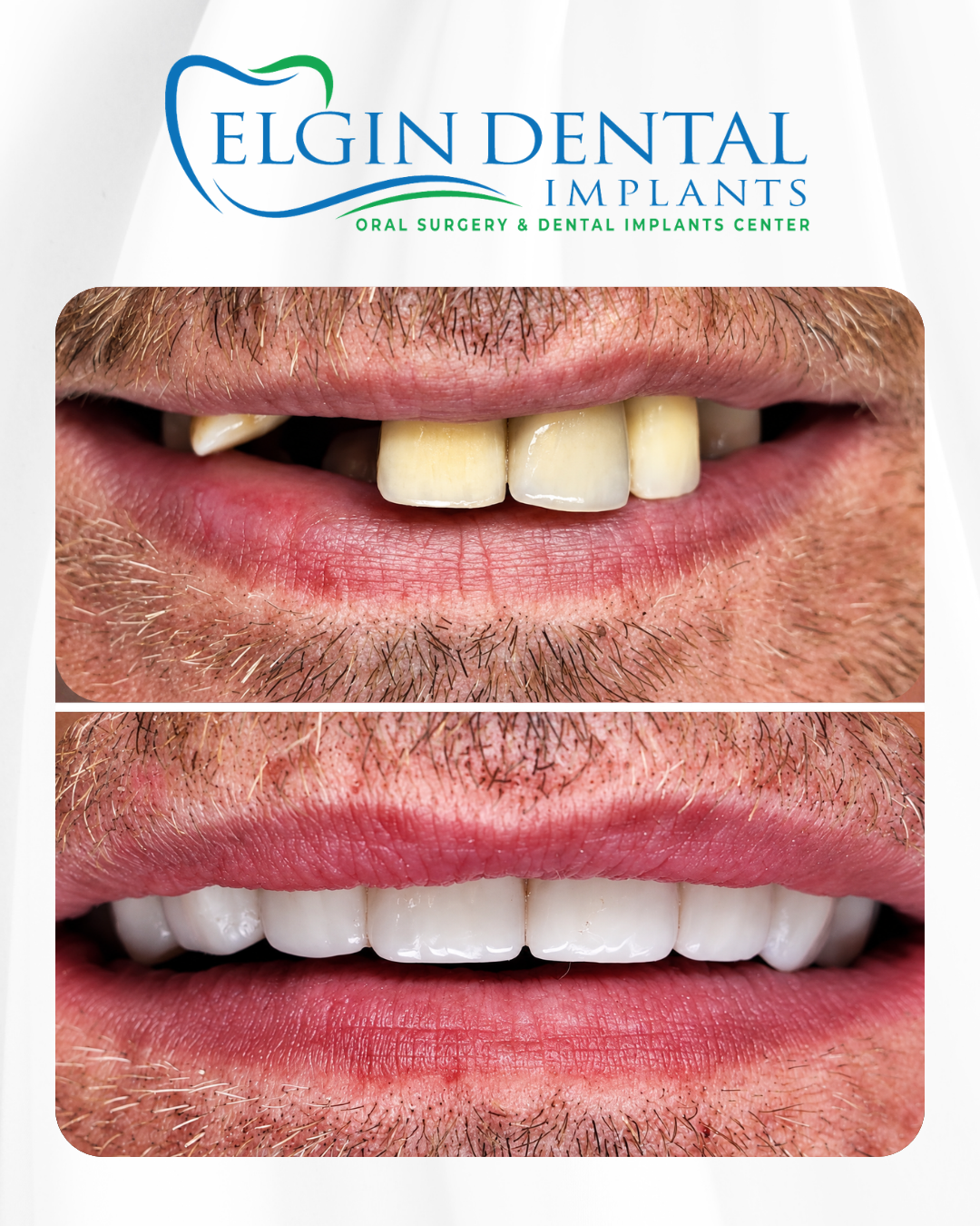 Elgin Dental Implants smile transformation 1, before and after