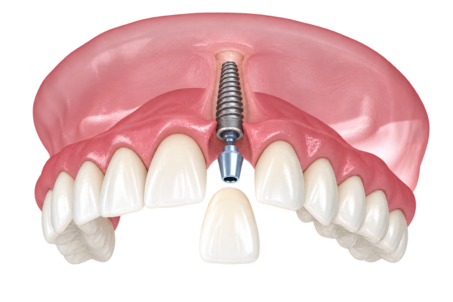 A single tooth implant, abutment, and crown illustrated within the smile