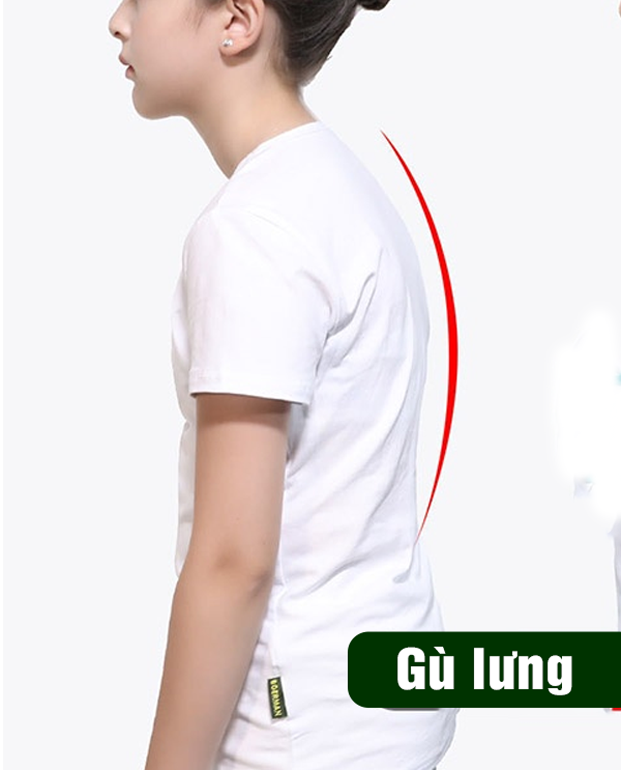 Gù lưng