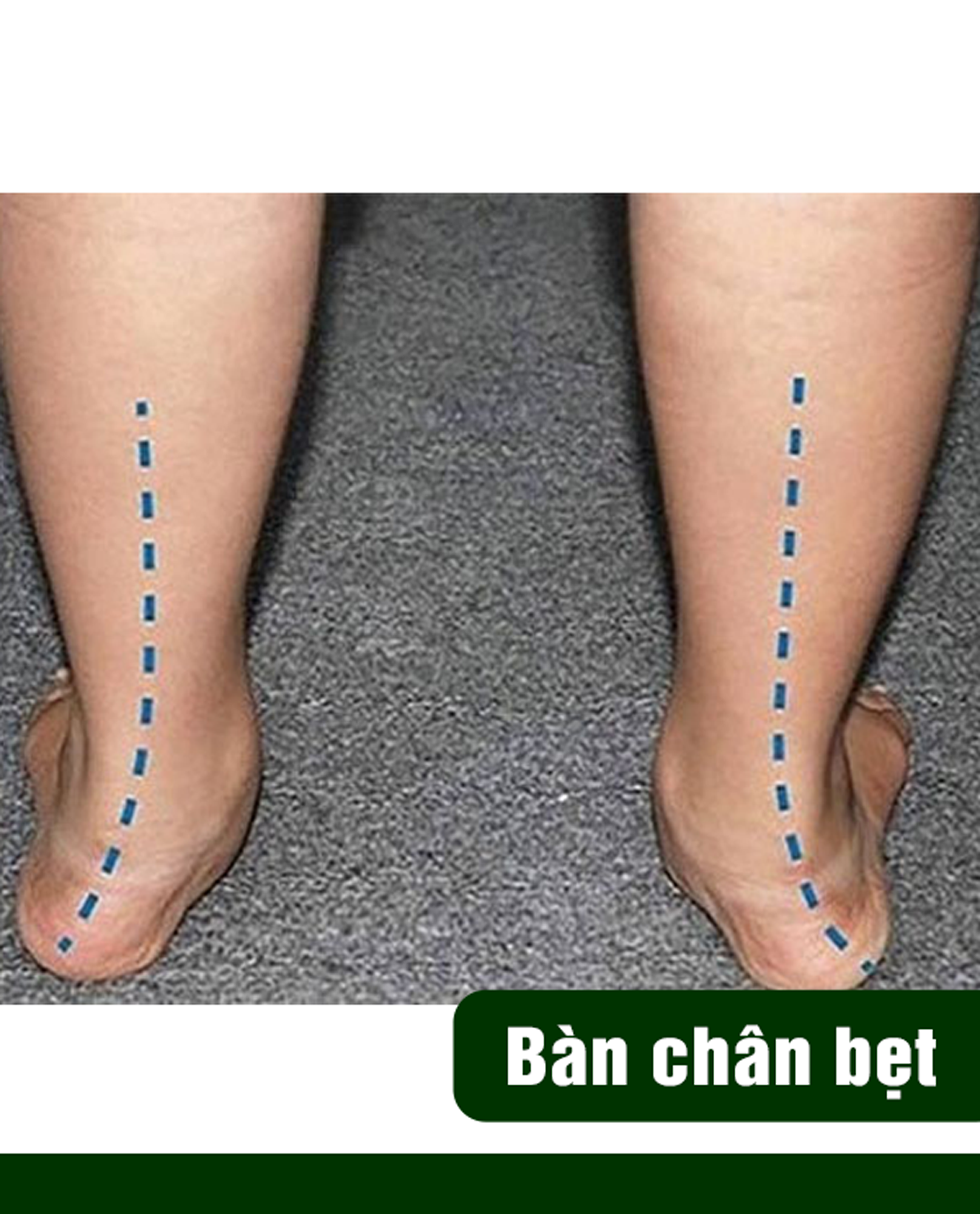 Bàn chân bẹt
