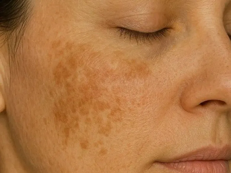 Melasma en el rostro