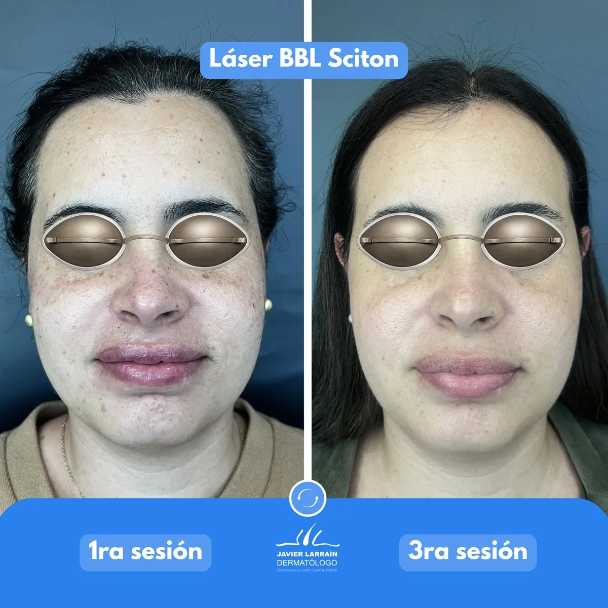 Antes y después en vista frontal: primera y tercera sesión de Láser BBL Sciton