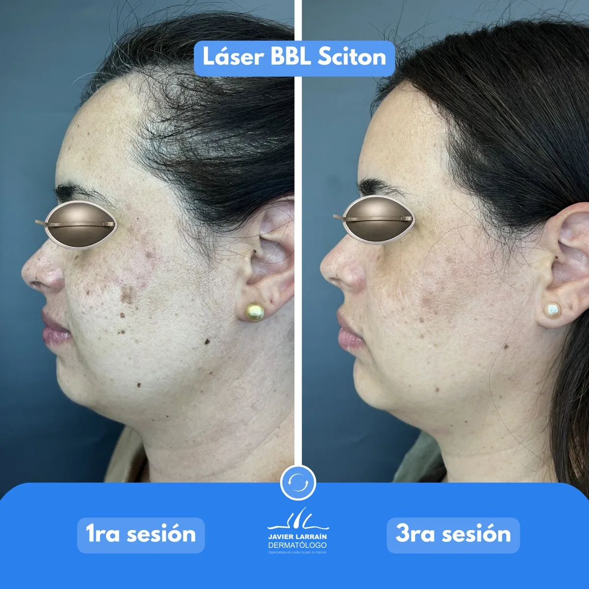 Antes y después en vista de perfil: primera y tercera sesión de Láser BBL Sciton