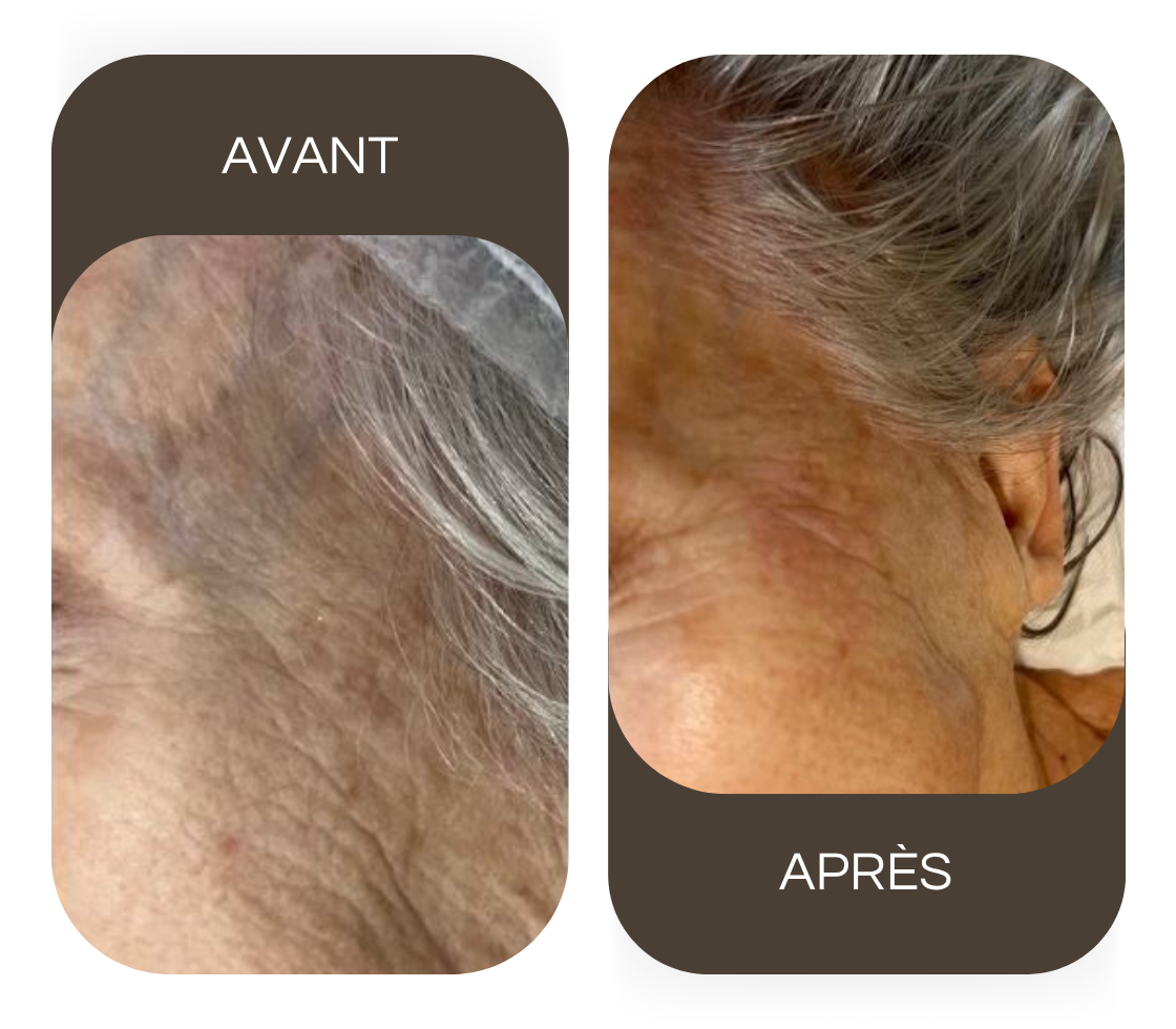 Avant / après Radiofréquence visage