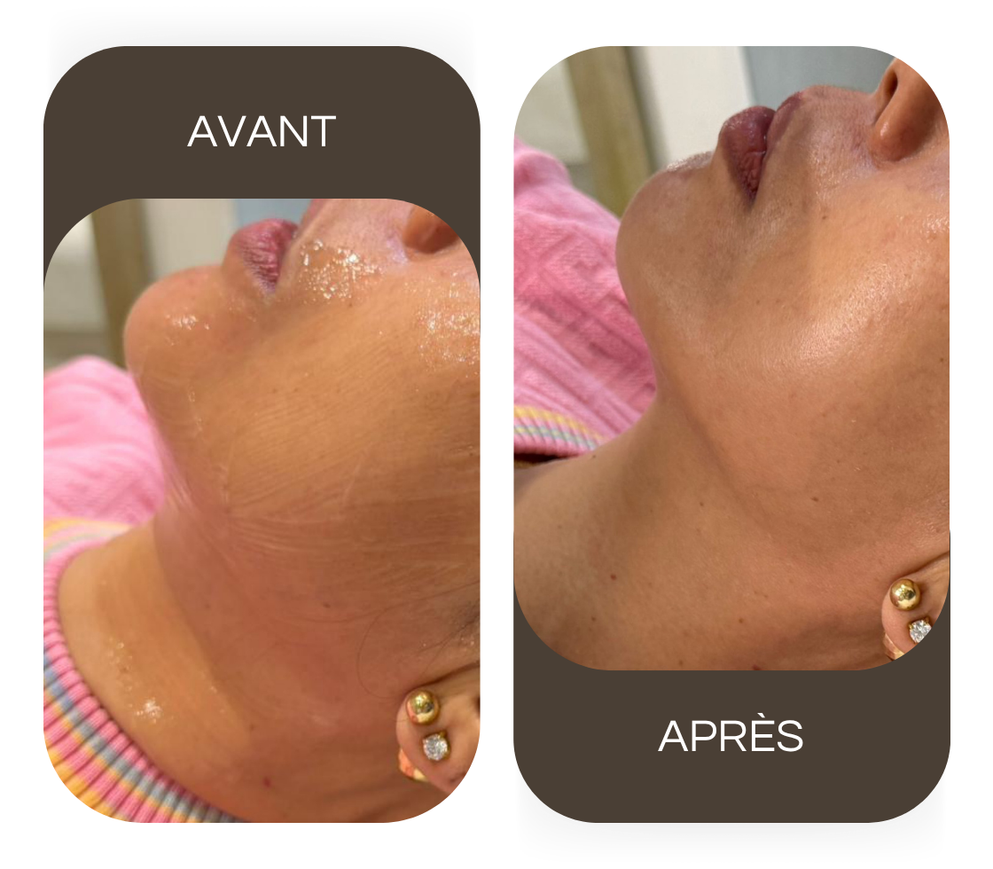 Avant / après Radiofréquence visage