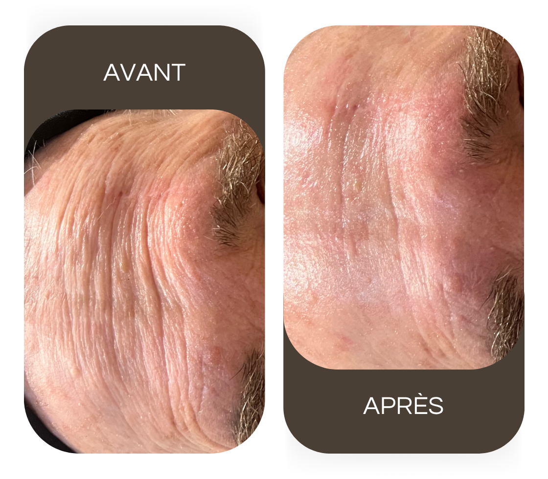 Avant / après Radiofréquence visage