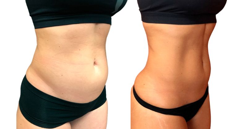 Laser lipo treatment moment