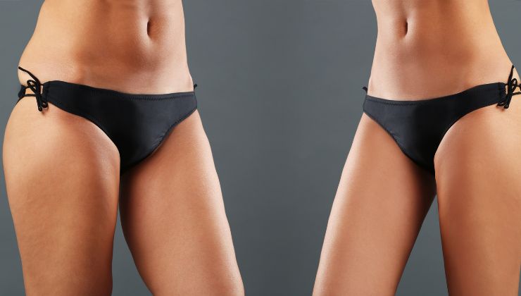 Laser lipo treatment moment