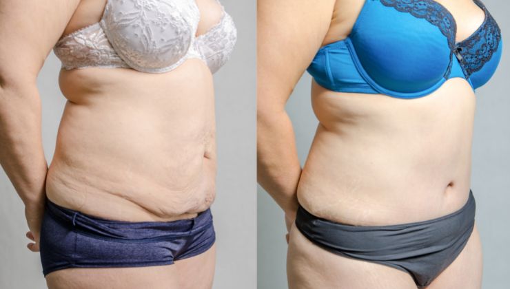 Laser lipo treatment moment