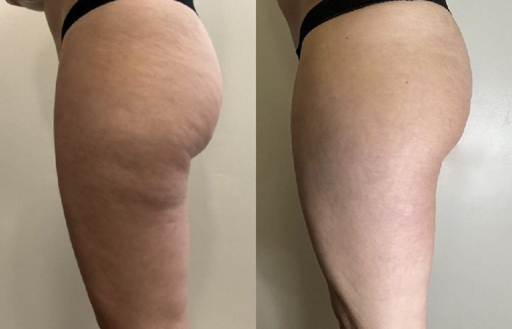LPG Endermologie body treatment before and after result 2