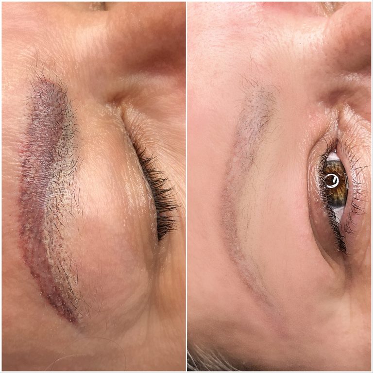 Tattoo removal — initial session
