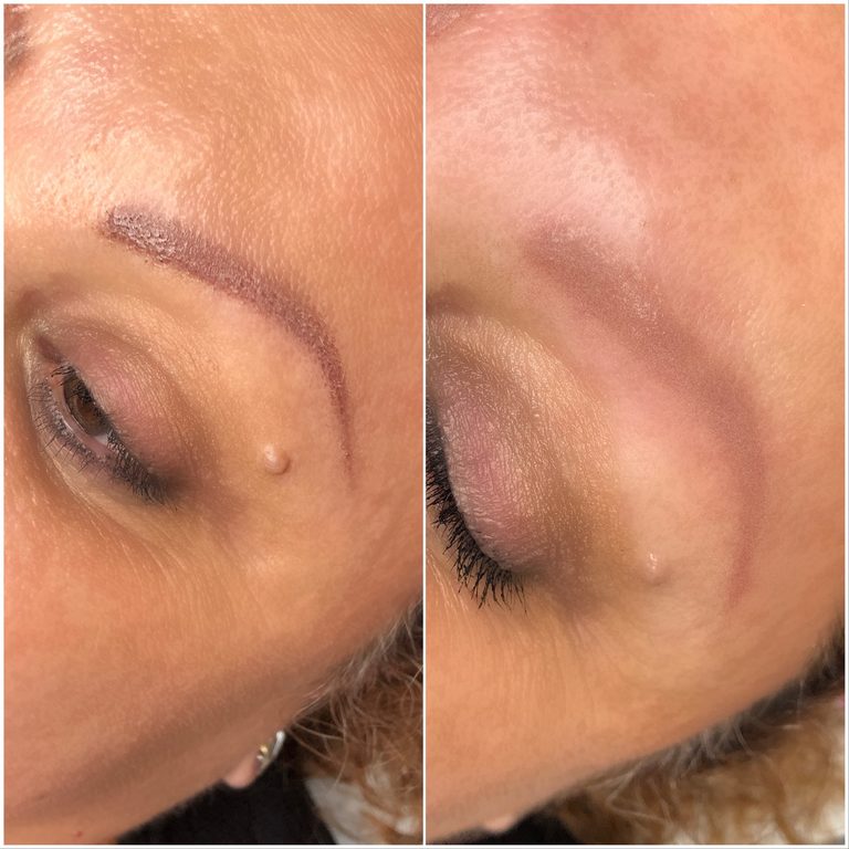 Tattoo removal — progress photo