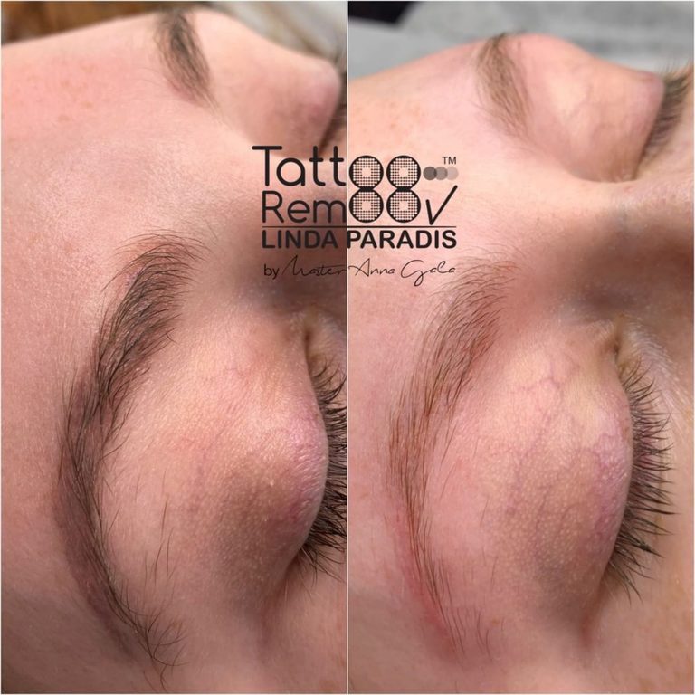 Tattoo removal — healing phase