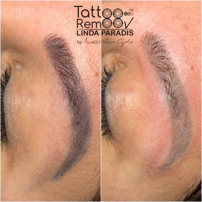 Tattoo removal — mid-progress
