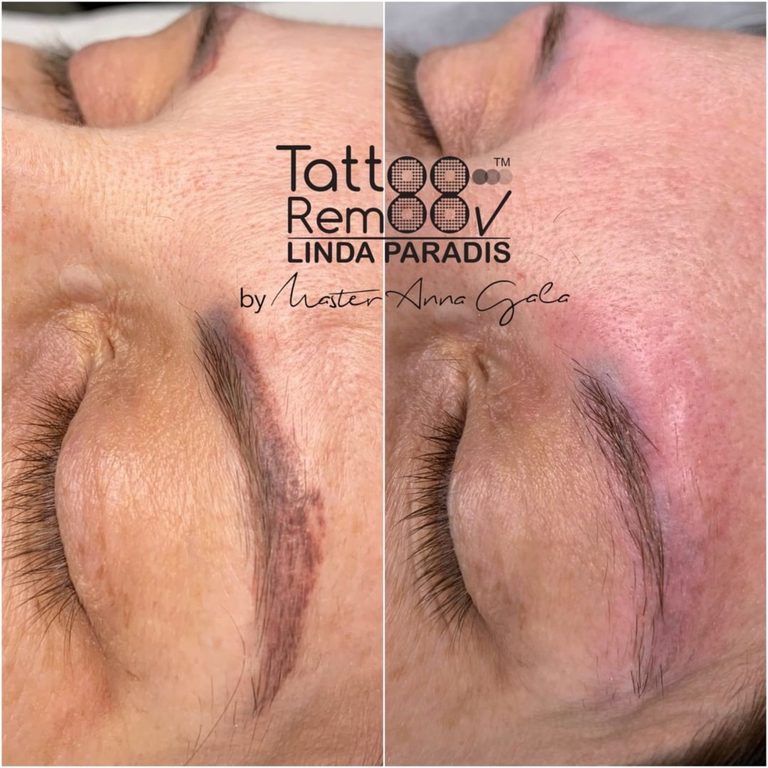 Tattoo removal — fade visible