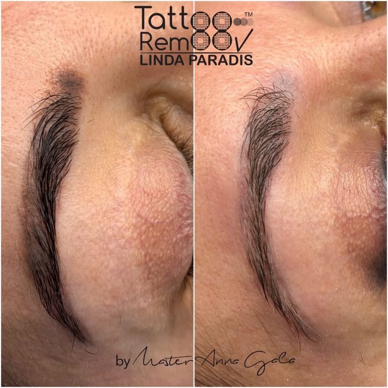 Tattoo removal — final result