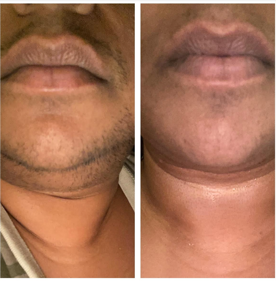 Before non-laser hair removal at Nu Way Beauty