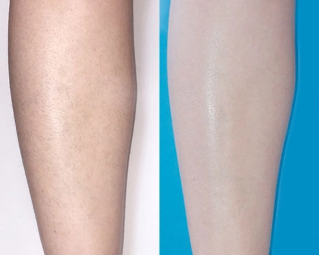 Before and after non-laser hair removal — area 3