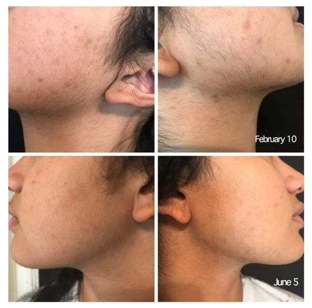 Before and after non-laser hair removal — area 4
