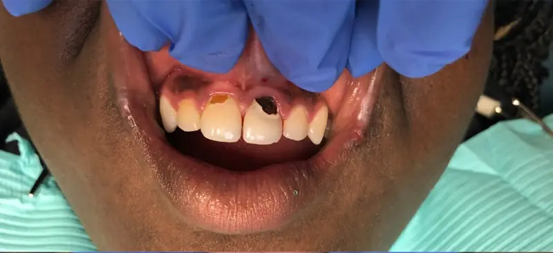 Before: severely decayed front tooth with visible cavity