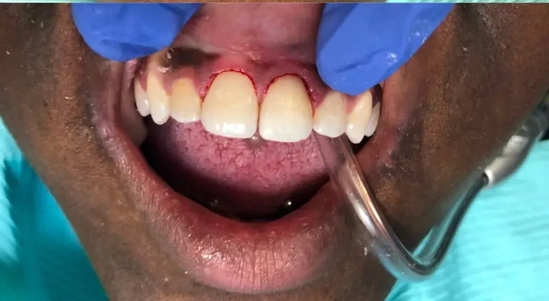 After: front tooth fully restored with composite filling