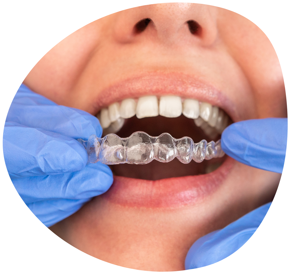 Image d'aligneur transparents pour aligner les dents
