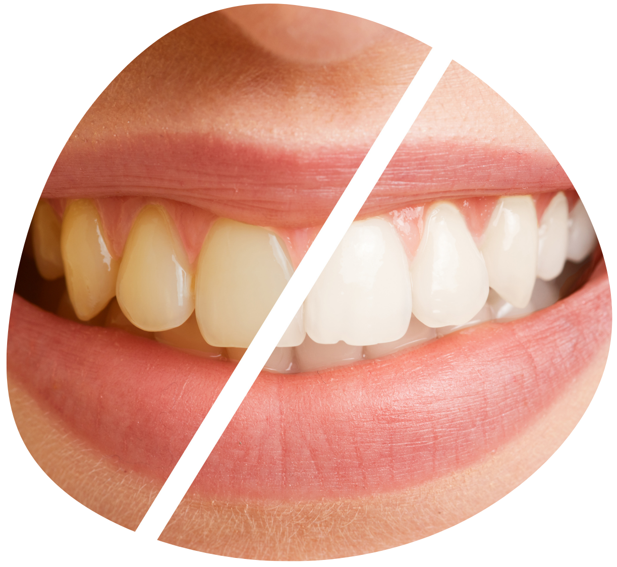 Image de blanchiment des dents