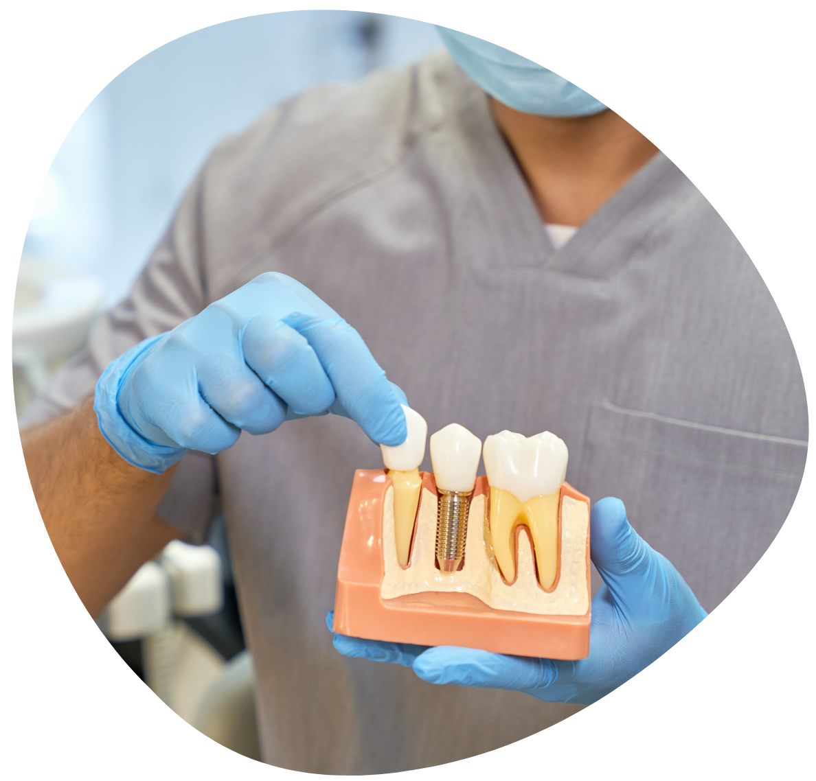 Image d'un implant dentaire
