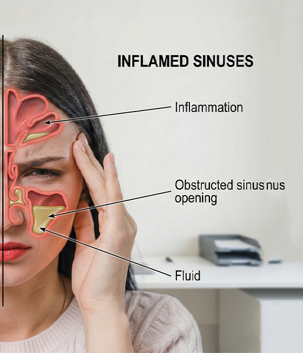 Sinusitis
