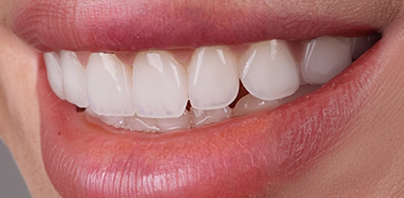 Dental Veneers