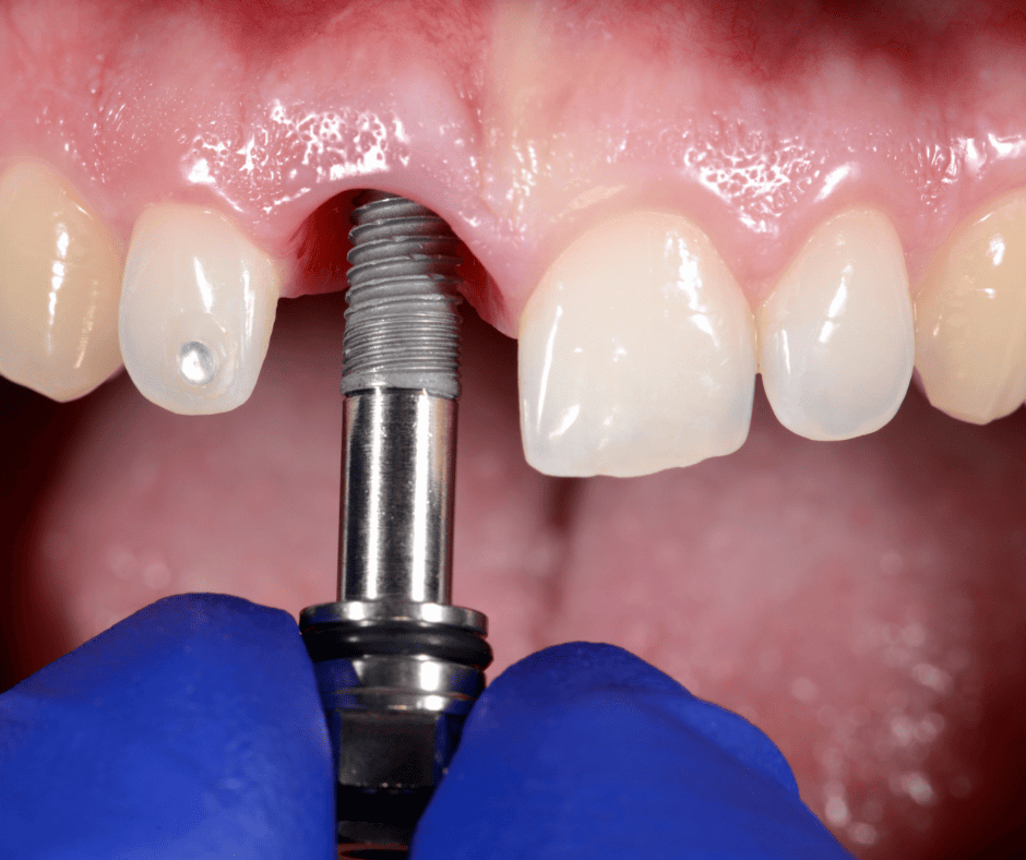 Implantes dentales