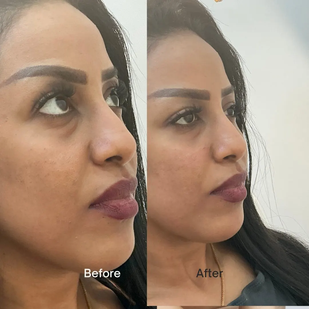 Before and after of a real JENNVIE Med Spa client in Westport, CT