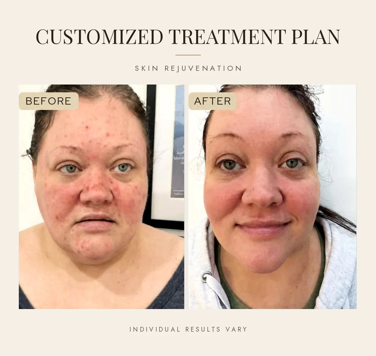 Customized treatment plan for skin rejuvenation, before and after on a real JENNVIE client in Westport, CT