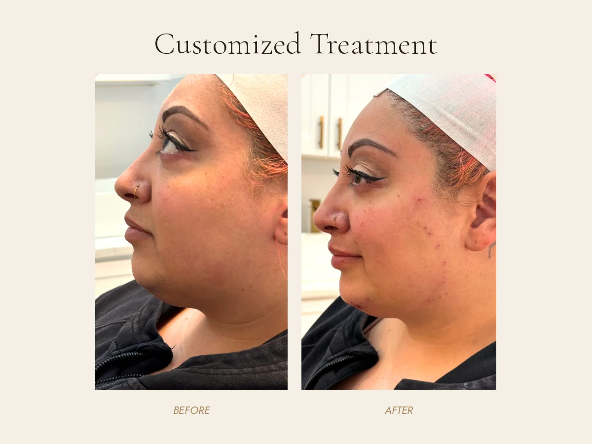 Before and after of a customized treatment at JENNVIE Med Spa in Westport, CT, real client