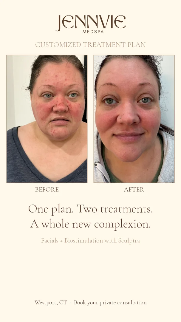 Before and after: facials plus Sculptra biostimulation at JENNVIE Med Spa, Westport, CT, real client