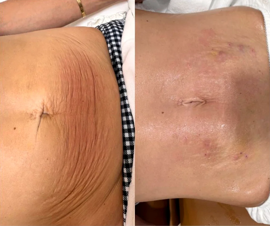 Venus RF skin tightening before and after on the abdomen at JENNVIE Med Spa, Westport, CT