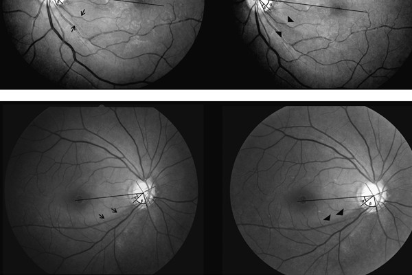 Effects of Misalignments in the Retinal Nerve Fiber Layer Thickness ...