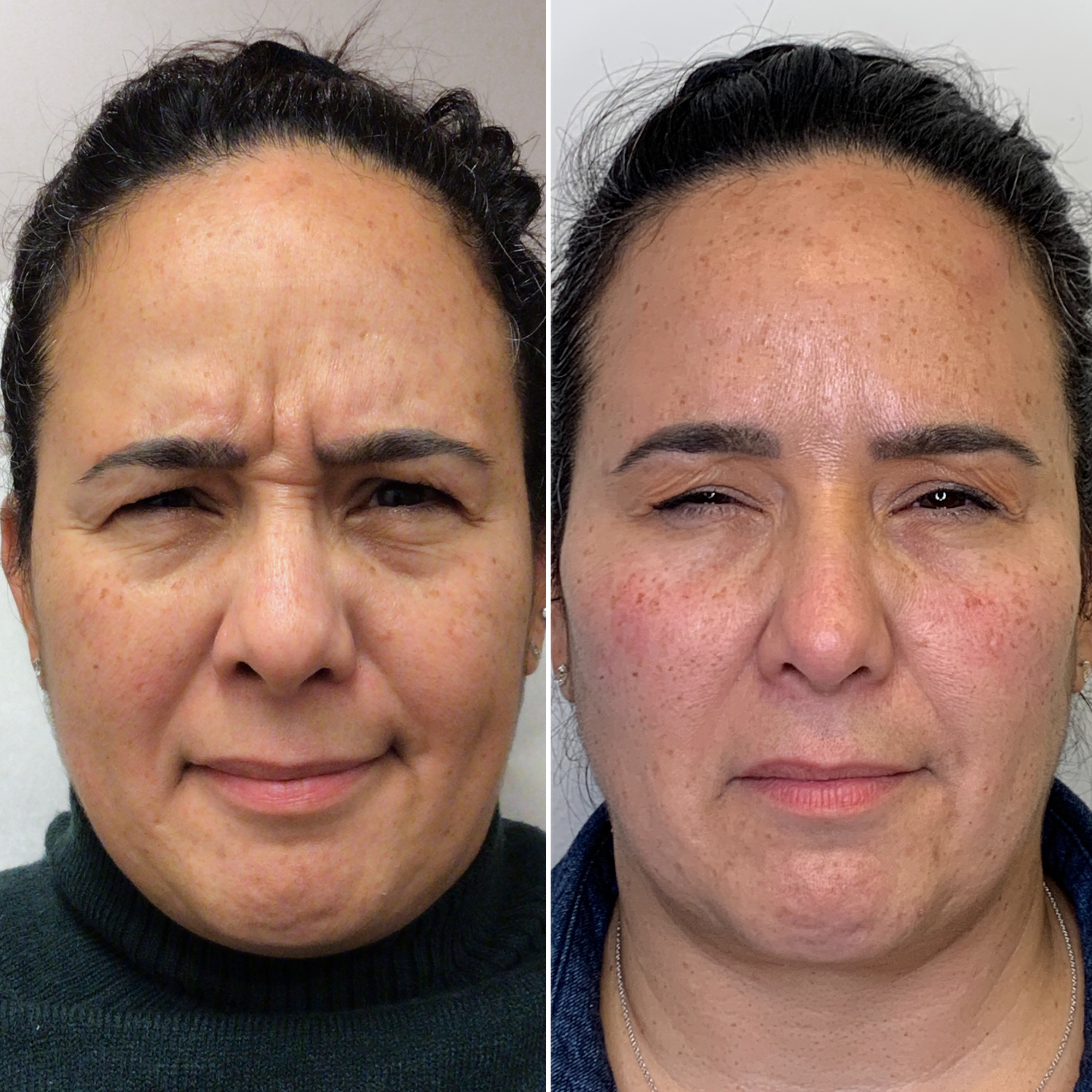 Before and after: frown lines