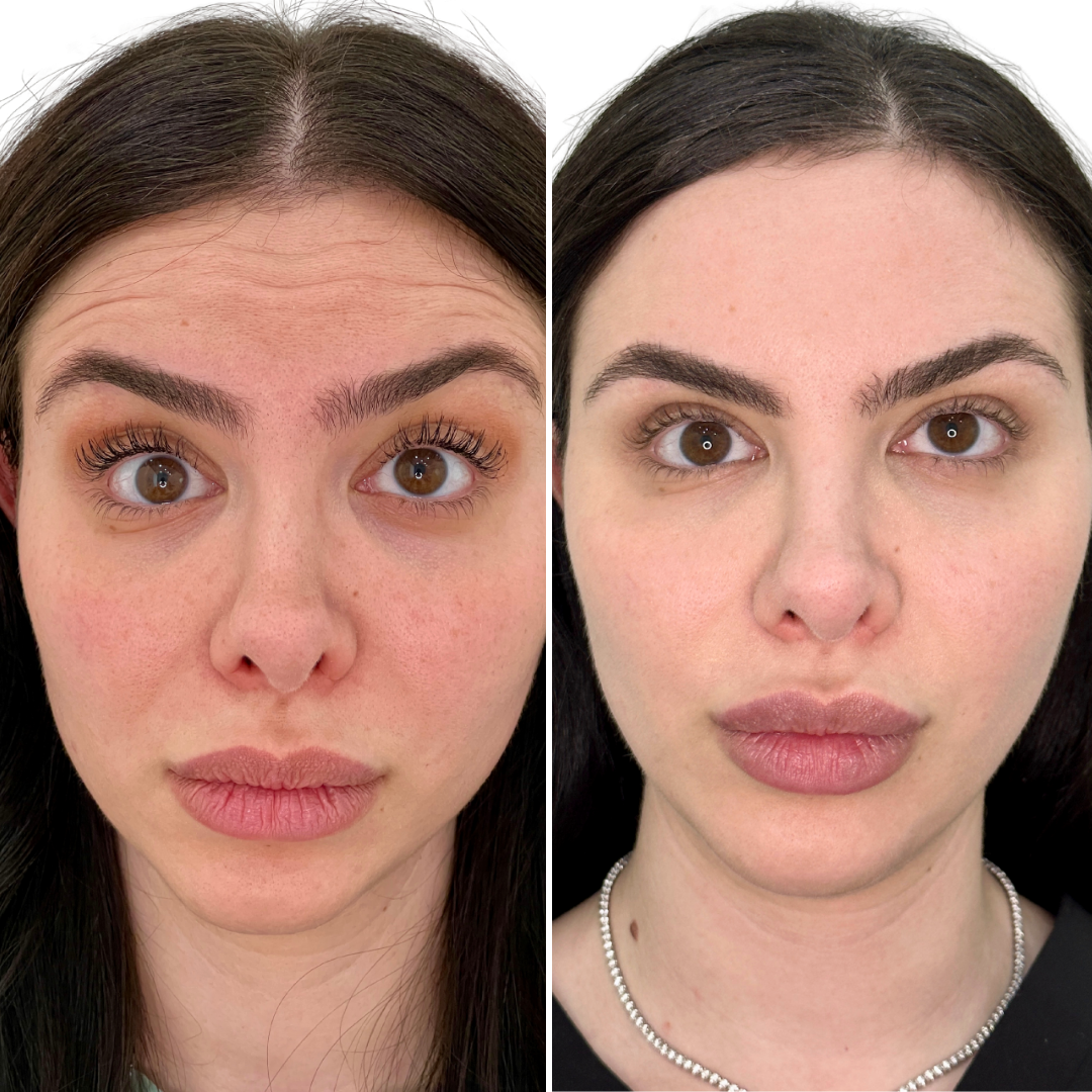 Before and after: forehead lines