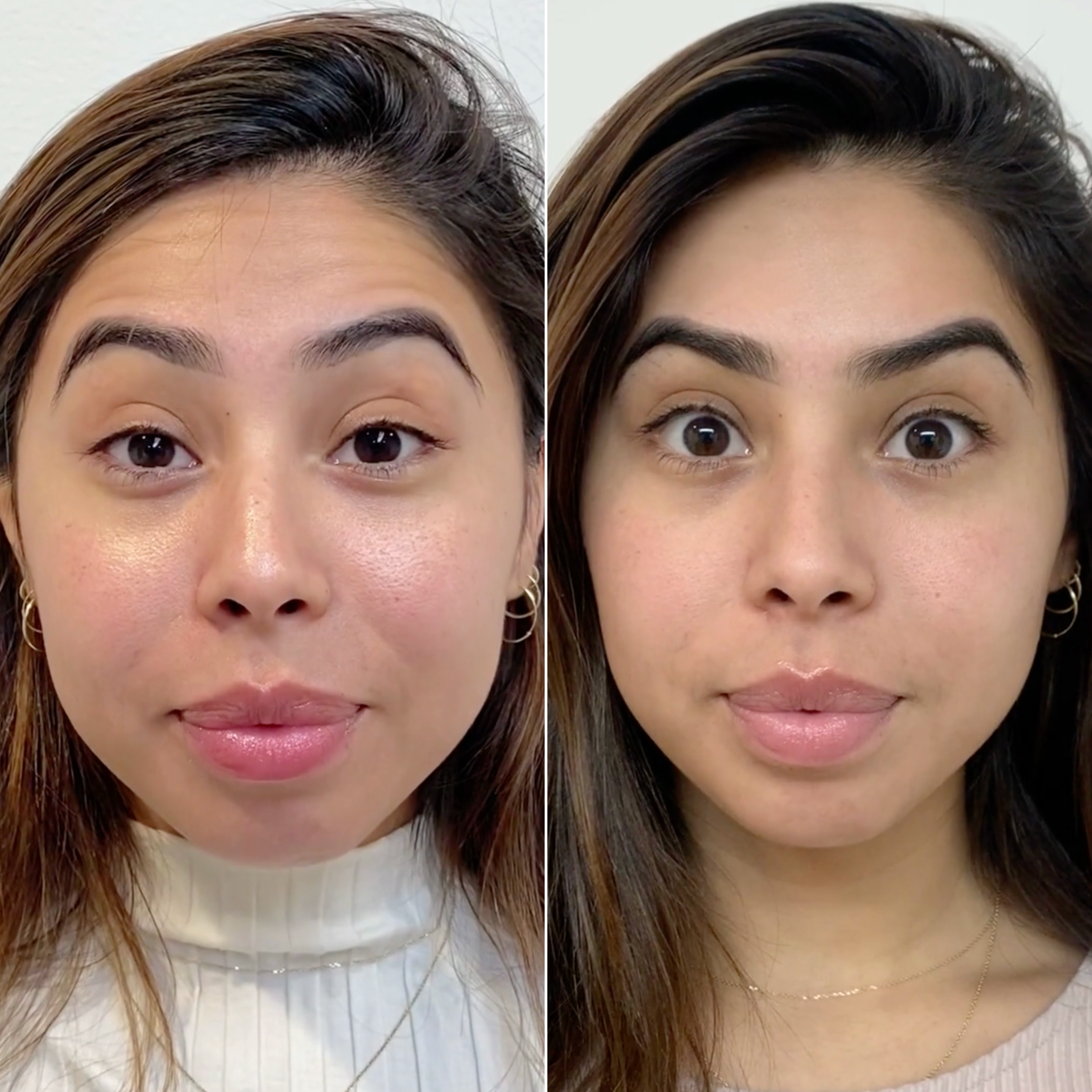 Before and after: forehead lines
