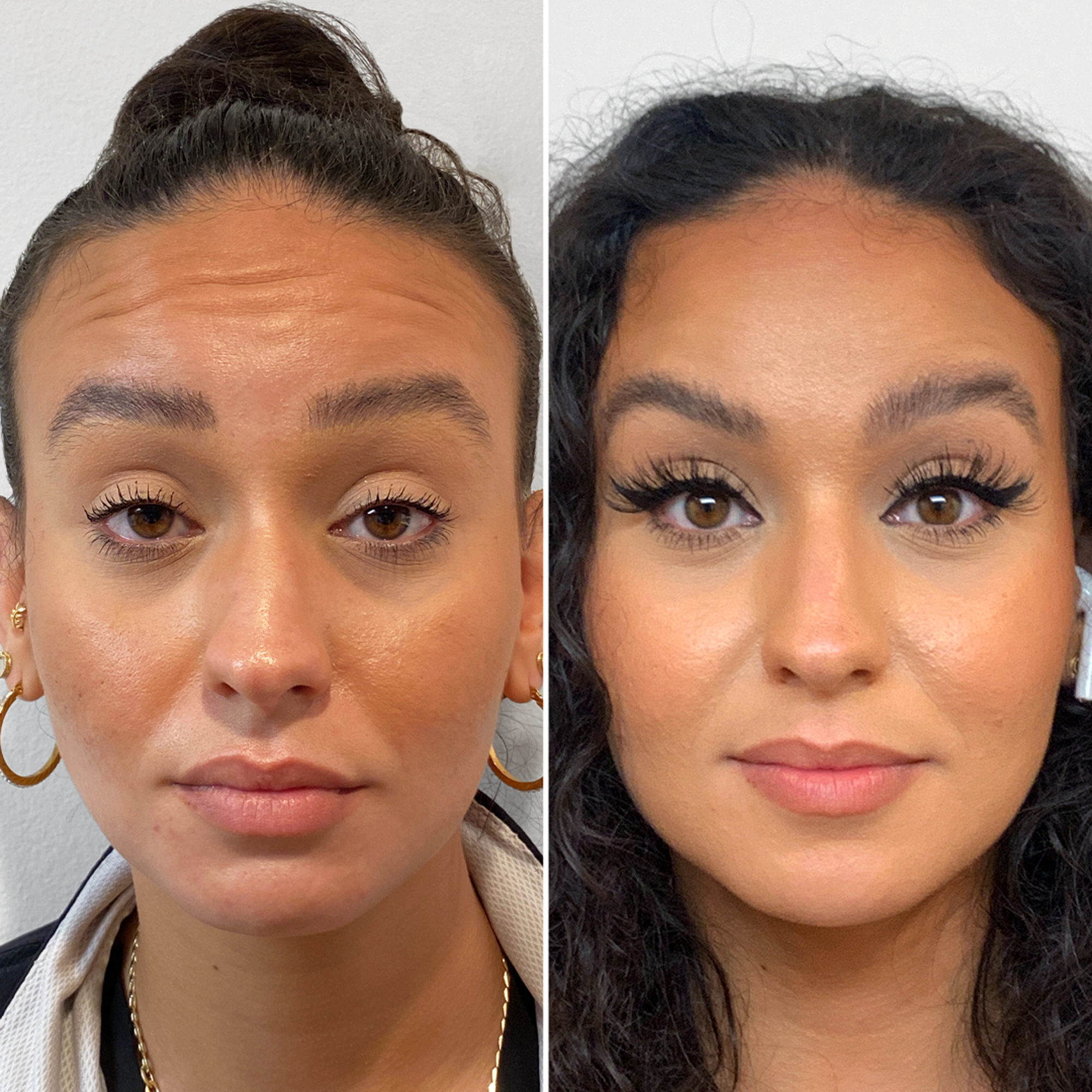 Before and after: forehead lines