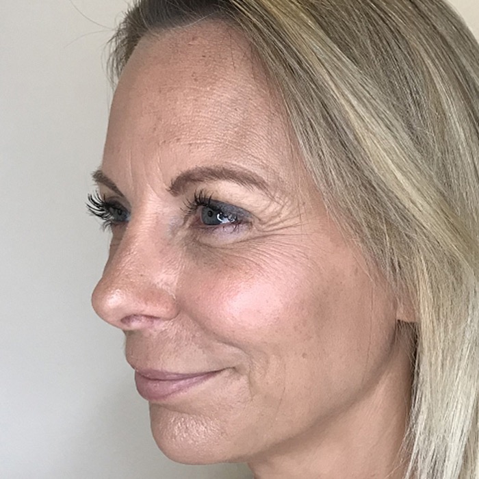 Før: rynkebehandling hos CeriX